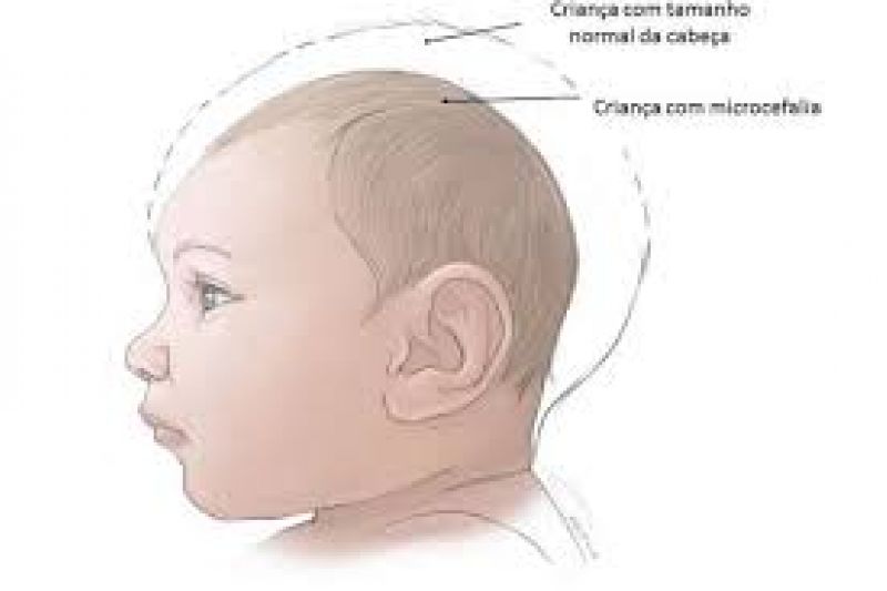 Ministério da Saúde investiga 4.293 casos de microcefalia no país