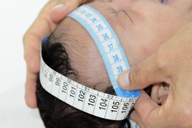 Ministério da Saúde confirma 41 casos de microcefalia em Alagoas