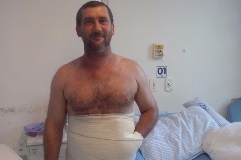 Para evitar amputação, homem ficará com mão dentro do abdômen