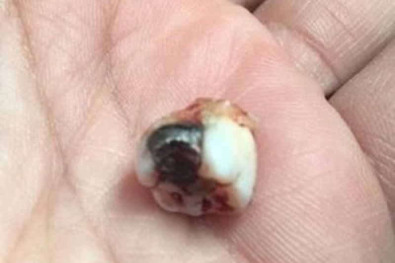 Homem leva tiro durante roubo e escapa após bala ficar alojada em dente