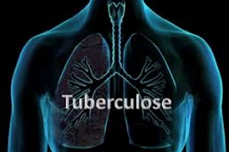 Secretaria de Saúde confirma que Delmiro Gouveia passa por surto de tuberculose