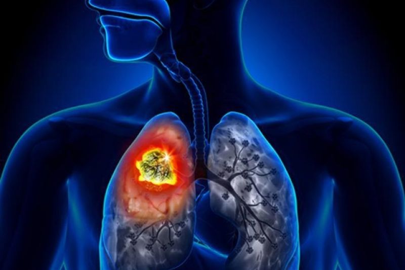 Ações de prevenção e combate à tuberculose iniciam nesta segunda (12) em Delmiro Gouveia