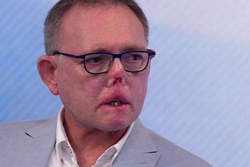 Homem perde pernas, dedos e parte do rosto após arranhão e lambida de cachorro