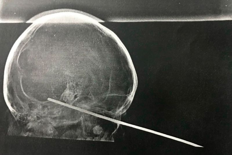 Menino de 8 anos tem espeto cravado no olho durante brincadeira com amigo