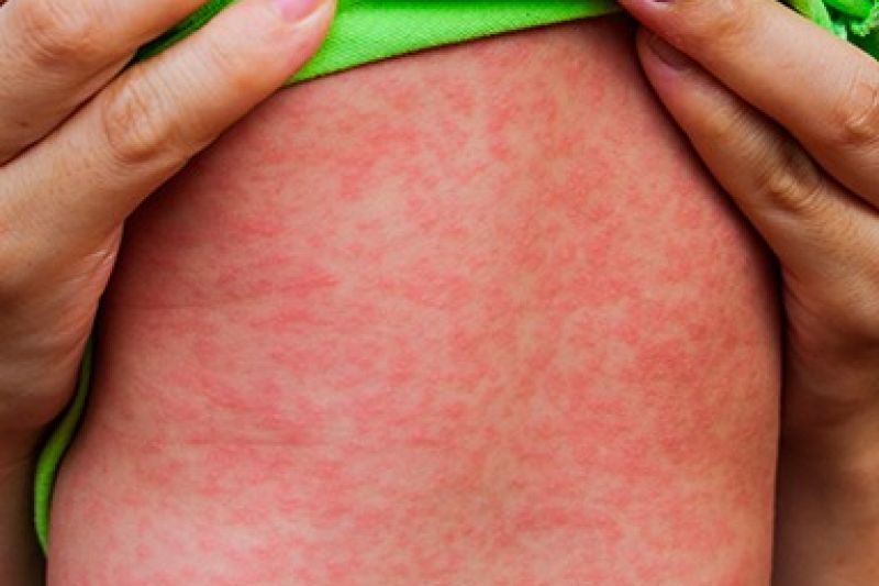 Campanha de vacinação contra poliomelite e sarampo começa nesta segunda-feira (6)