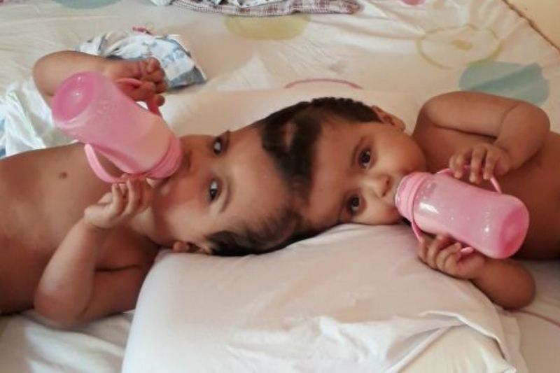 Siamesas unidas pela cabeça passam por 3ª cirurgia de separação em Ribeirão Preto
