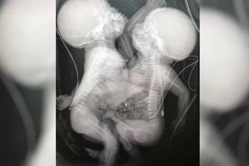 Gêmeas siamesas separadas respiram com ajuda de aparelhos e seguem em estado gravíssimo