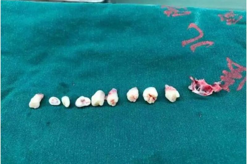 Médico retira nove dentes do cérebro de menino de cinco anos