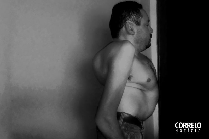 Portadores de escoliose vivem entre preconceito e esperança de melhora