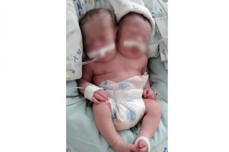 Morrem em SP gêmeas siamesas que estavam ligadas pelo tronco
