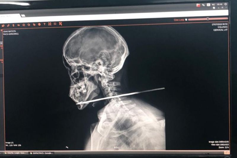 Homem tem pescoço perfurado por flecha ao tentar cruzar fronteira entre Guiana e Brasil