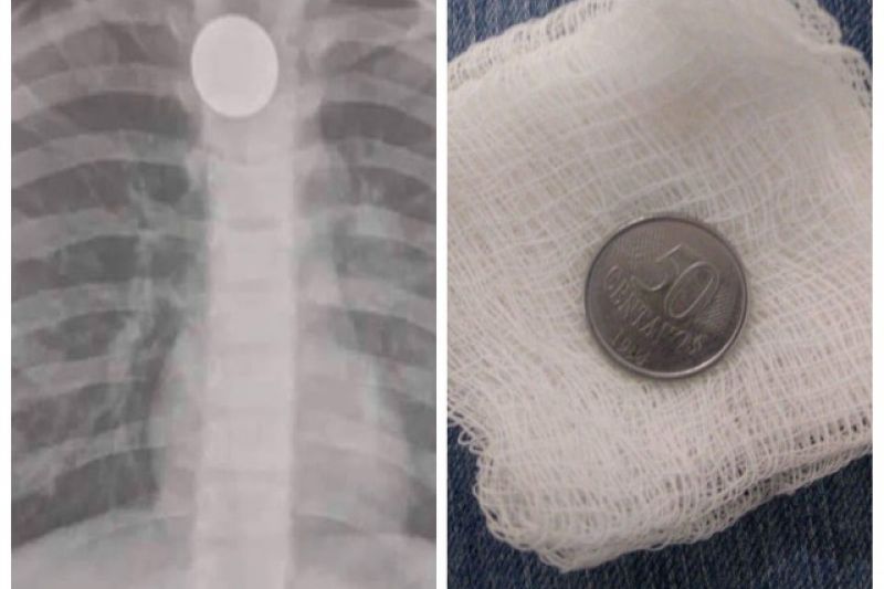 Após dois dias de espera, menina consegue exame para retirar moeda entalada no esôfago