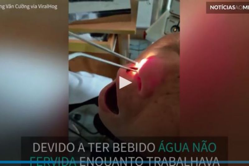 Sanguessuga é removida do nariz de agricultora que bebeu água contaminada