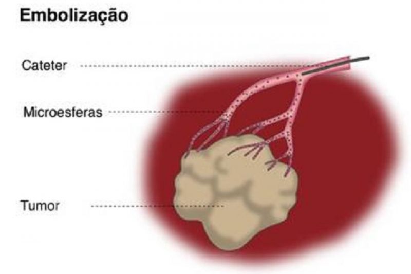 Procedimentos minimamente invasivos são opções no tratamento do câncer de fígado