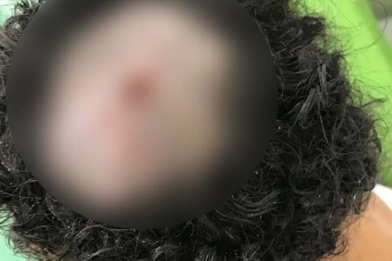 Médicos retiram 40 larvas que estavam comendo cabeça de criança em SP