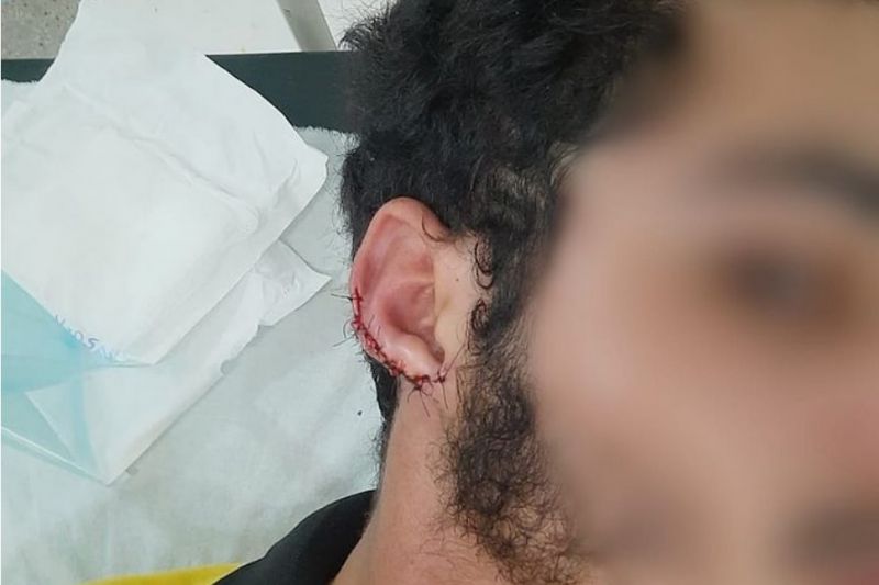 Chapeiro mordido na orelha por cliente sem dinheiro pede justiça em São José da Tapera