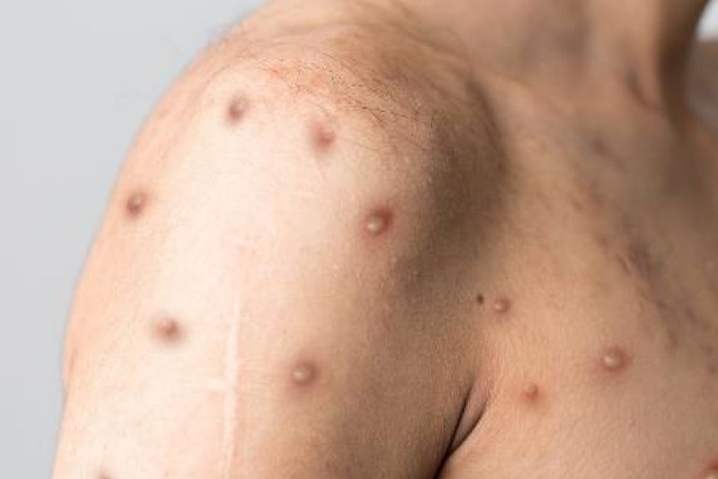 OMS declara varíola dos macacos como emergência de saúde global