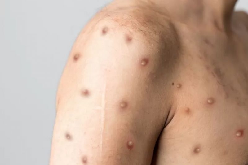 Queiroga diz que Brasil receberá antiviral contra a varíola dos macacos