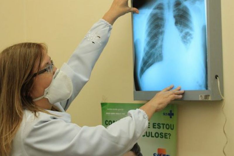 Governo cria comitê para eliminar a tuberculose