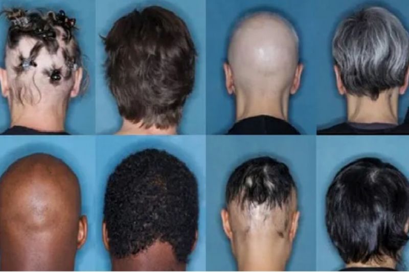 Anvisa aprova novo remédio contra queda de cabelo; preço é de R$ 5 mil