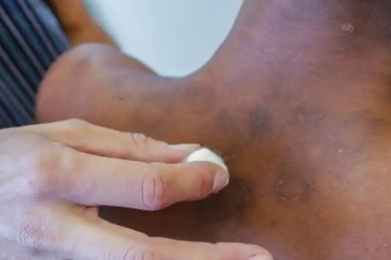 Novos casos de hanseníase aumentaram 5% de janeiro a novembro de 2023