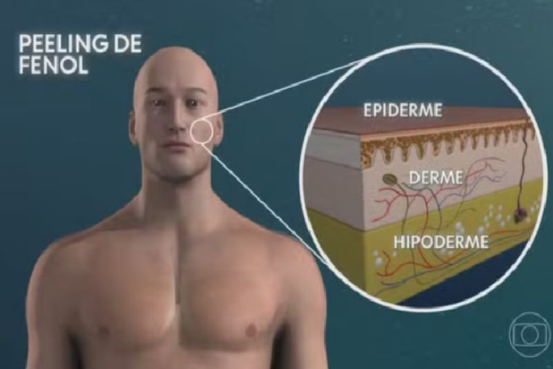 Saúde Anvisa proíbe temporariamente venda e uso de produtos à base de fenol