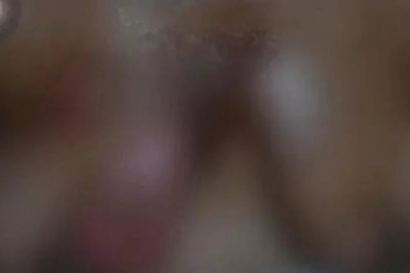 Mulher é queimada com óleo quente pelo companheiro em Mata Grande